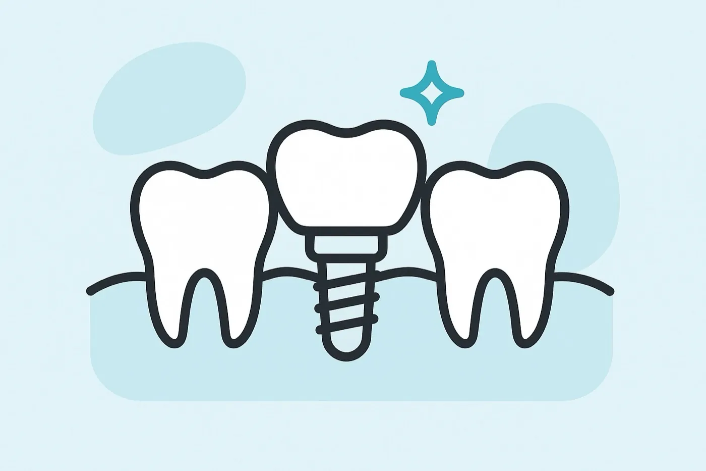 Illustration of a dental implant between natural teeth