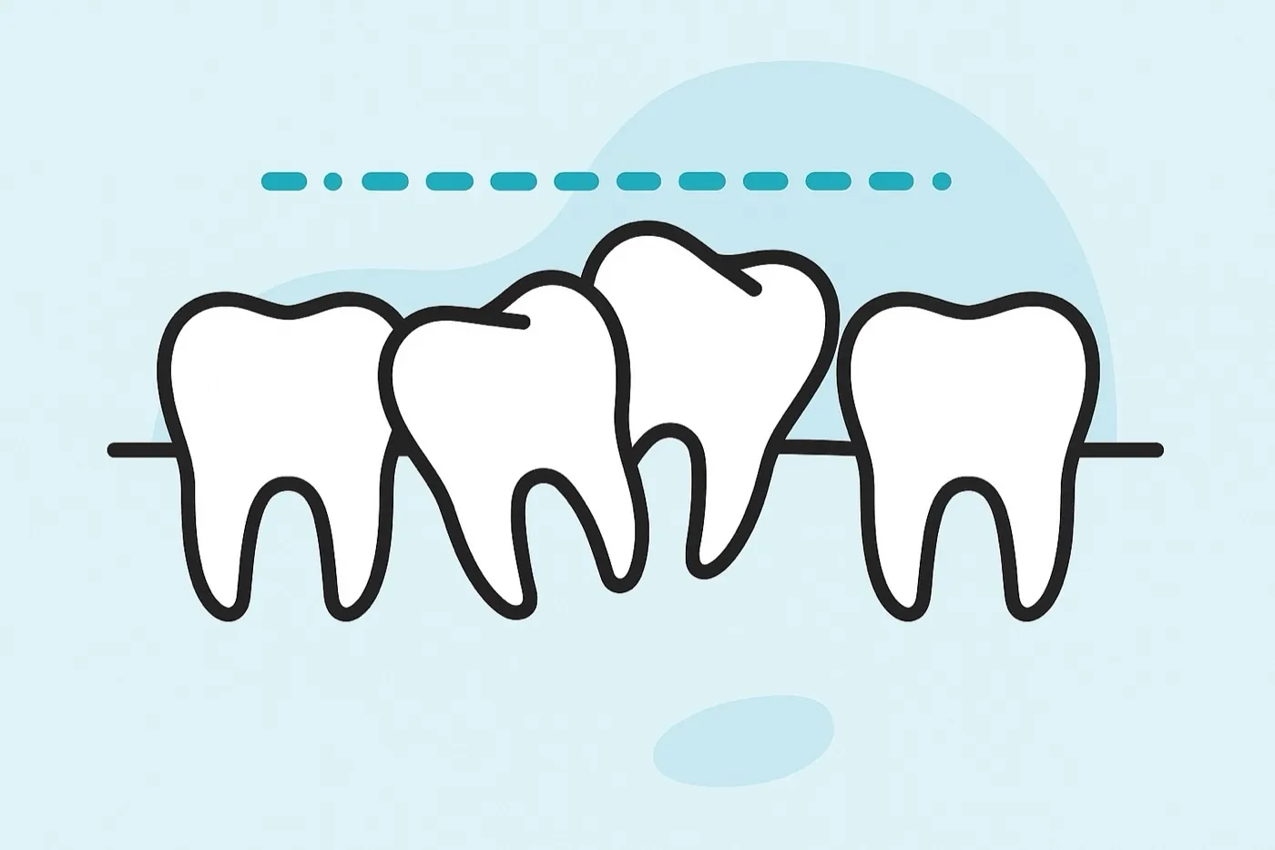 Illustration of crowded teeth below a straight guide line