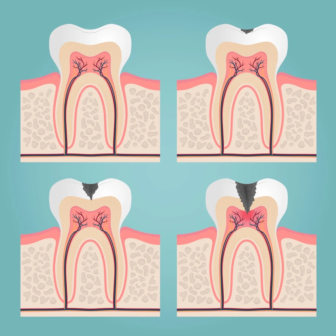 Root Canal