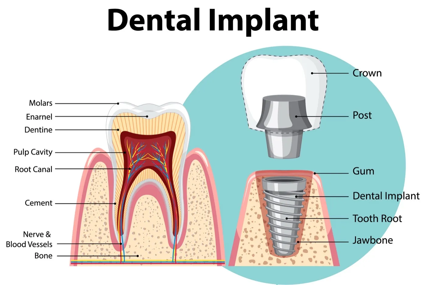 Dental Implants