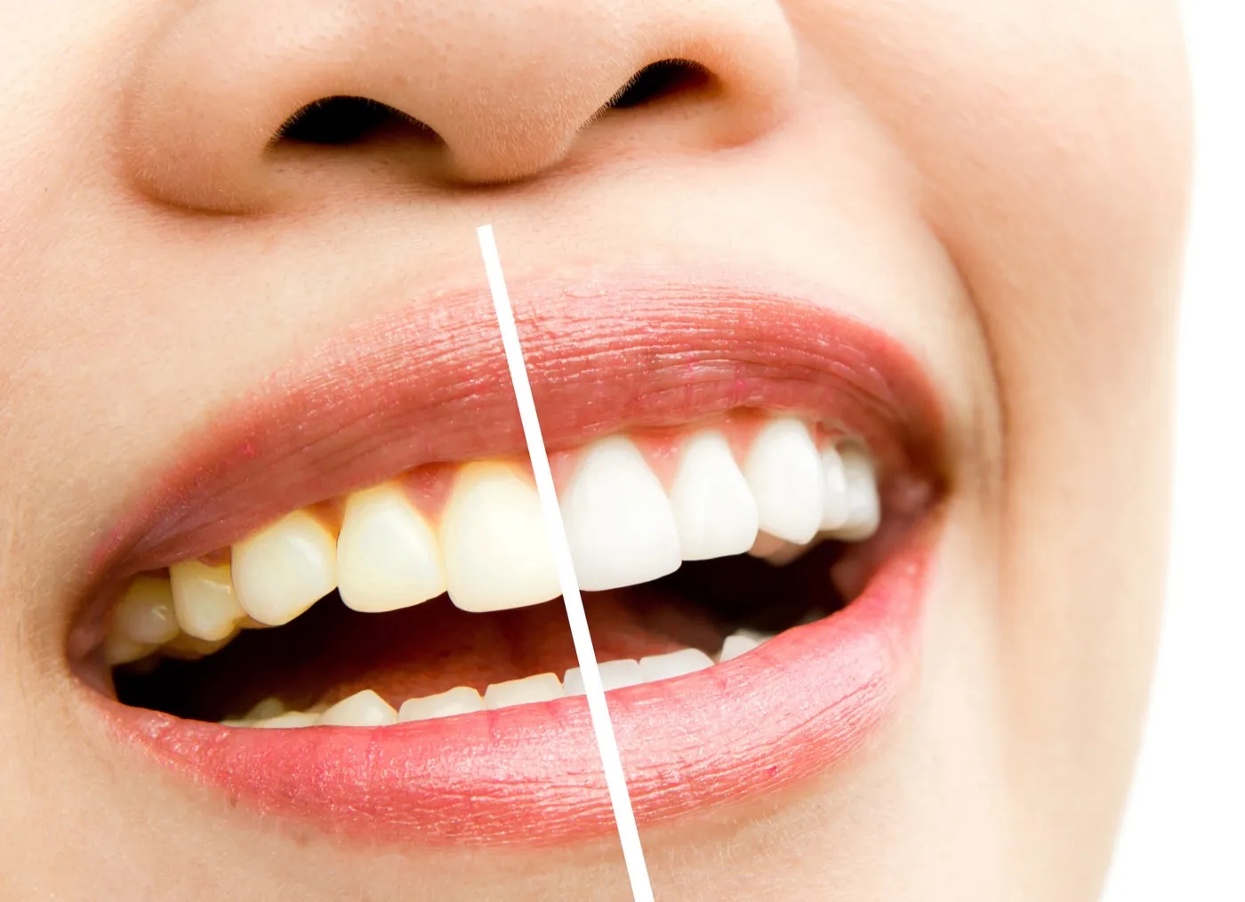 Teeth Whitening